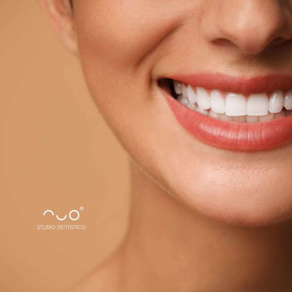 faccette dentali dentista acate