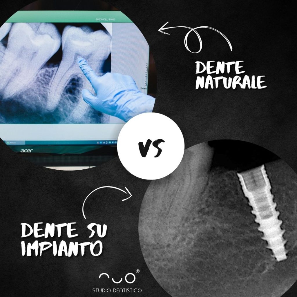 DENTE NATURALE O IMPIANTO