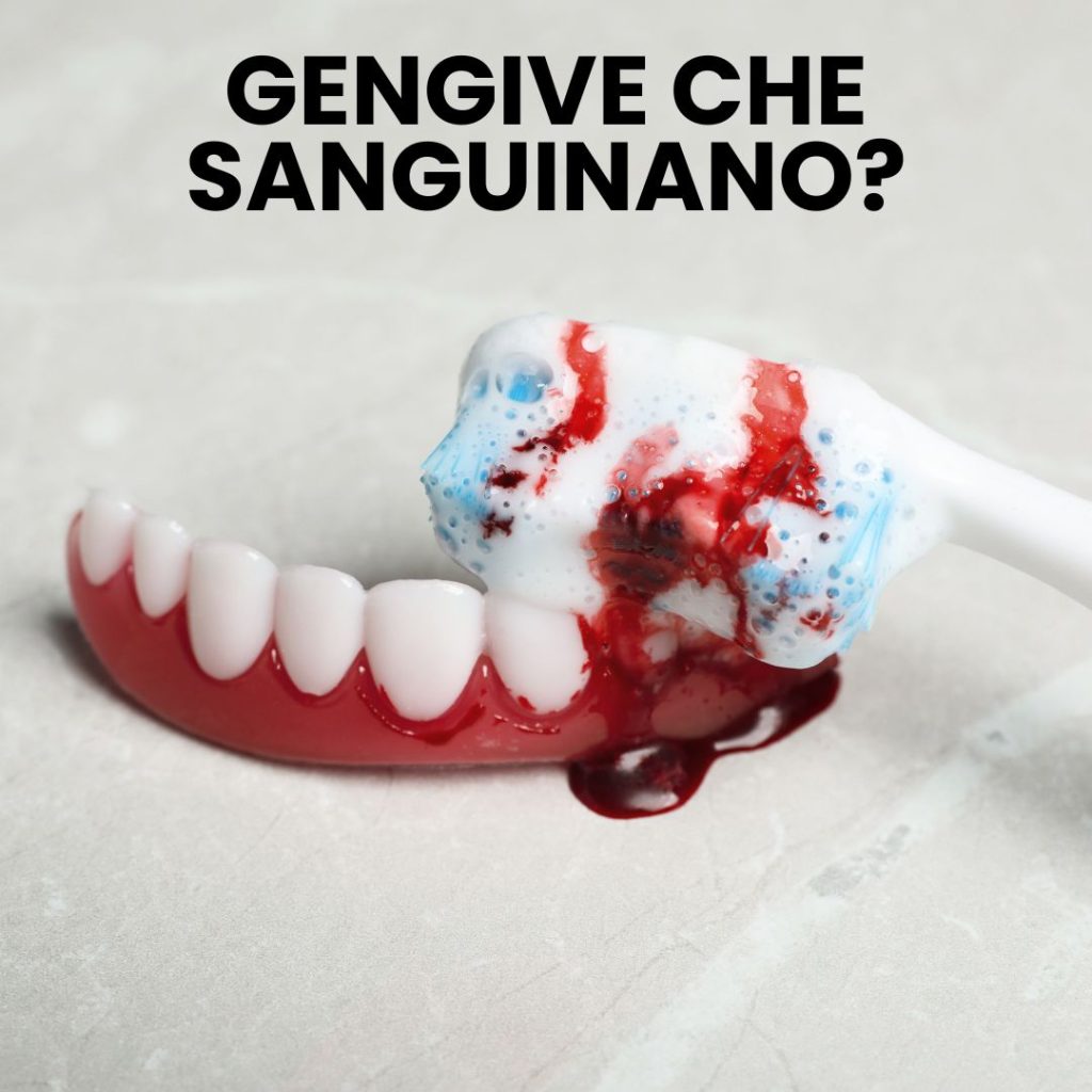 gengive che sanguinano