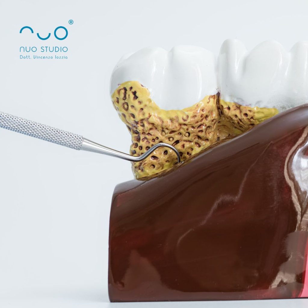 parodontite vittoria